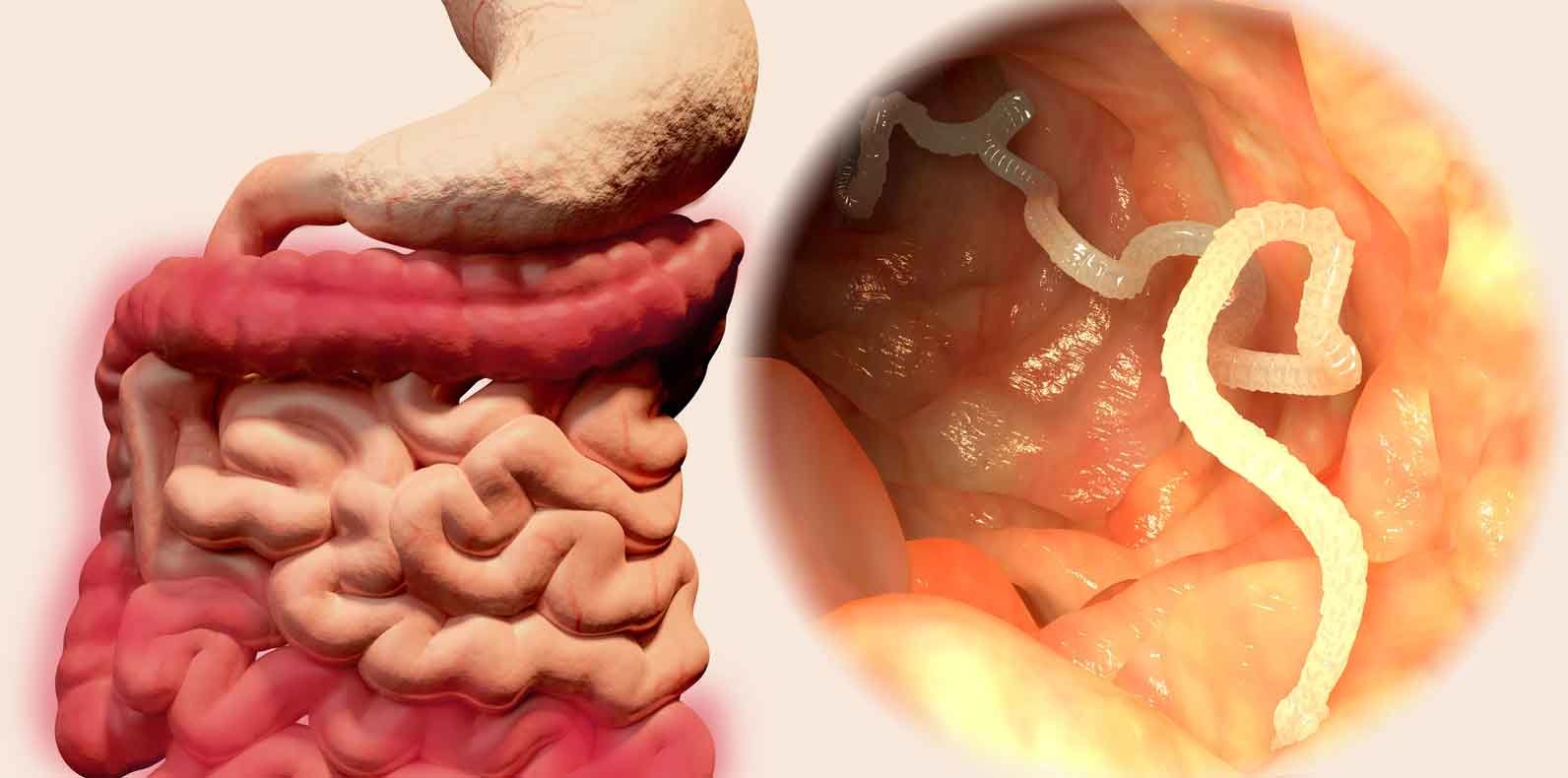 Tasiemczyca Spos B Zaka Enia Diagnoza I Leczenie Tasiemczycy