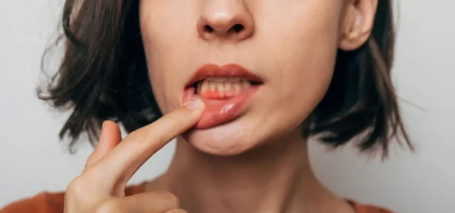 Jak zapobiegać powstawaniu ran w jamie ustnej?